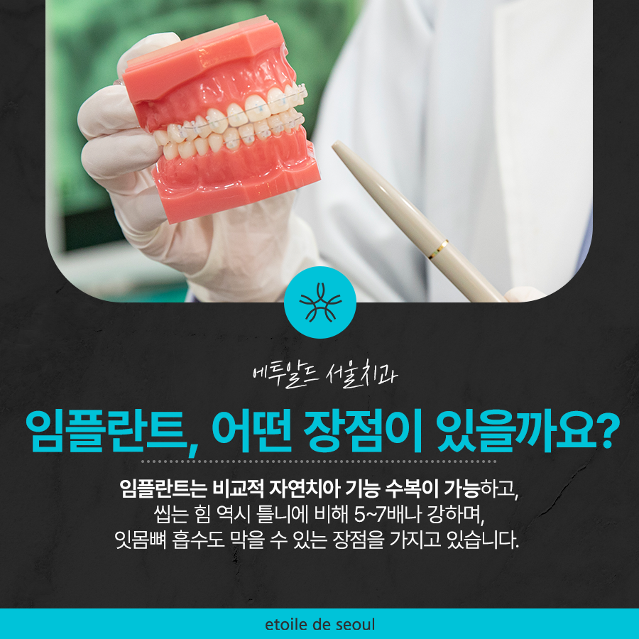 강남 어금니 임플란트 고려가 필요한 4가지! 관련 이미지 2