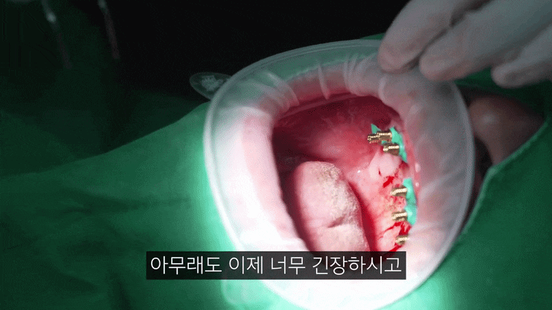 압구정치과 뼈이식 없는 임플란트 나도 가능할까 관련 이미지 8