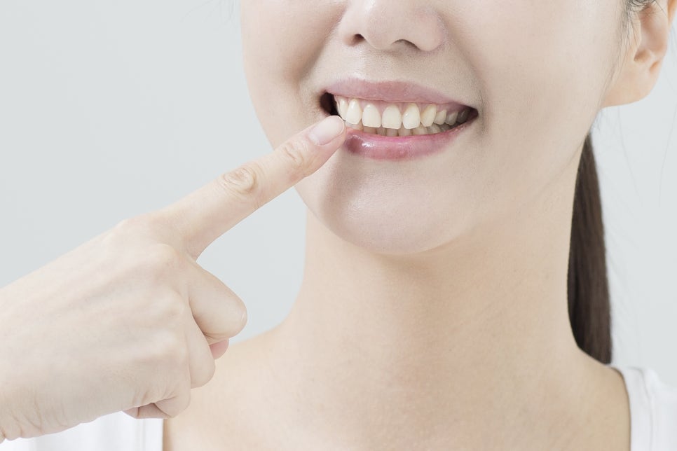 압구정역 임플란트 무치악으로 곤란한가요? 관련 이미지 22