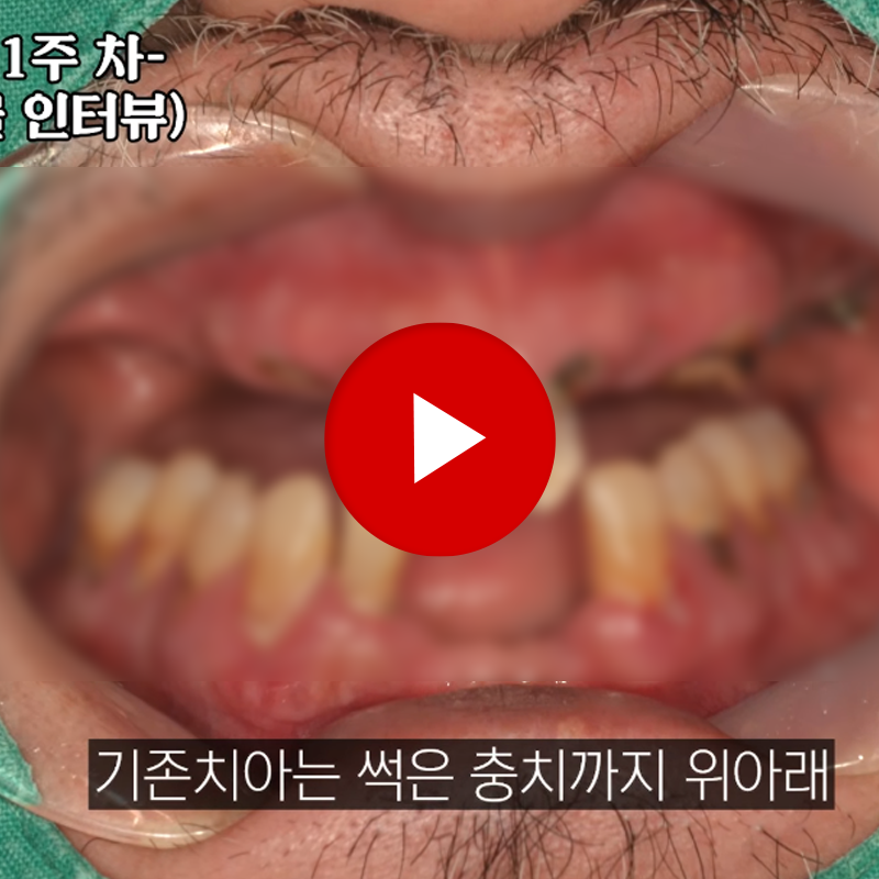 The Changes You Would Hate to Miss If You Overlook the Full-Arch Implant Recovery Period image 2