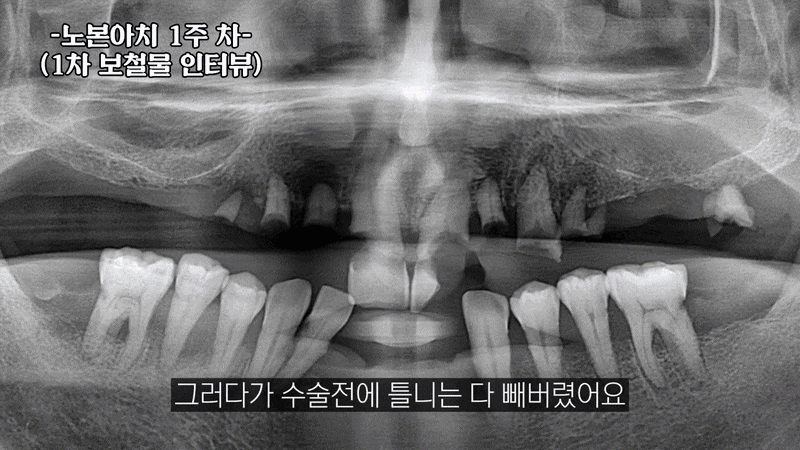 뼈이식 없는 임플란트 통증 상담 전 현직 치과의사가 짚어주는 부분 관련 이미지 5