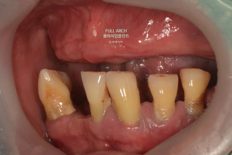 풀아치임플란트 무엇? full-arch Process 부작용과 주의할 점. 관련 이미지 7