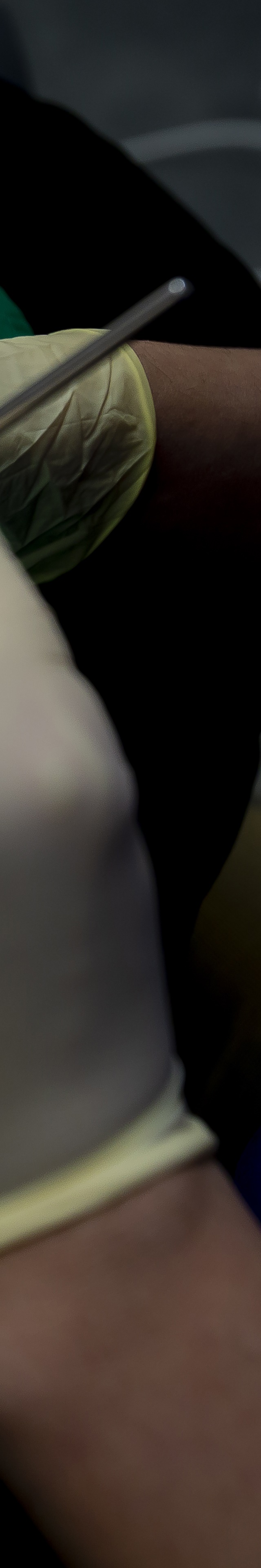 아랫니 라미네이트 숨겨왔던 미소를 되찾는 여정 관련 이미지 21