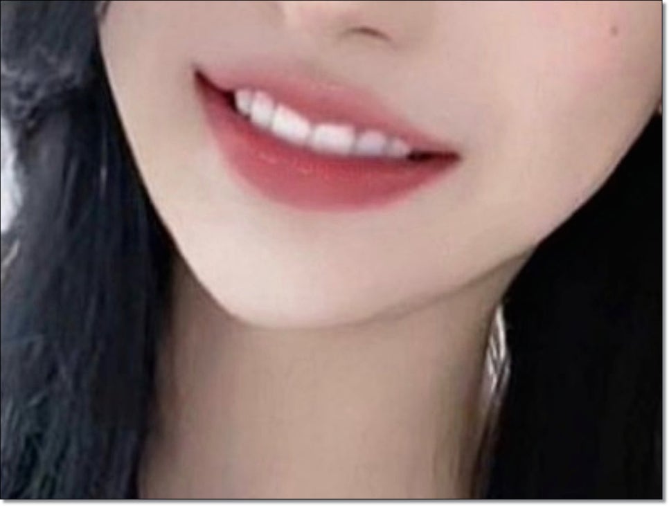 신사동 무삭제 라미네이트 모두 가능한가요? 관련 이미지 3