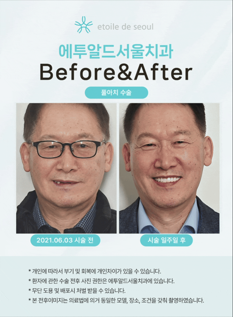 임플란트 수명을 위해 관리하는 방법 관련 이미지 3