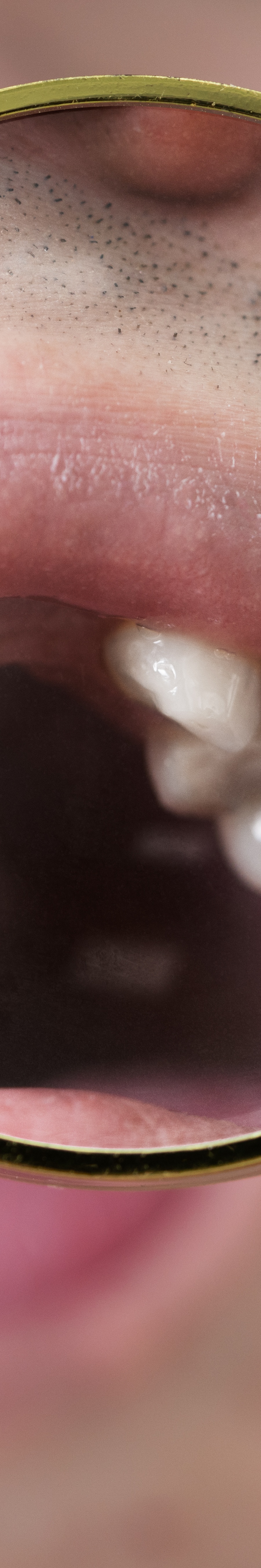 올온엑스 임플란트 과연 해결이 가능할까 관련 이미지 34