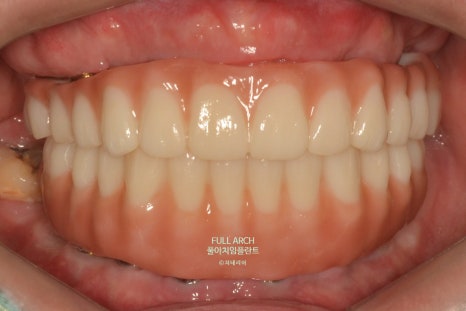 풀아치임플란트 무엇? full-arch Process 부작용과 주의할 점. 관련 이미지 12