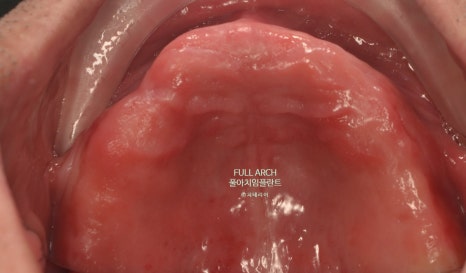 풀아치임플란트 무엇? full-arch Process 부작용과 주의할 점. 관련 이미지 8