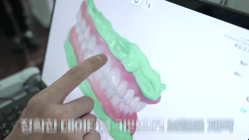 풀아치임플란트후기 결정 전 확인해야할 사항 관련 이미지 9