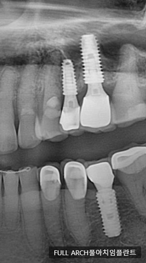 임플란트의 역사와 구조, 풀아치 임플란트 구조 차이점 비교 관련 이미지 5