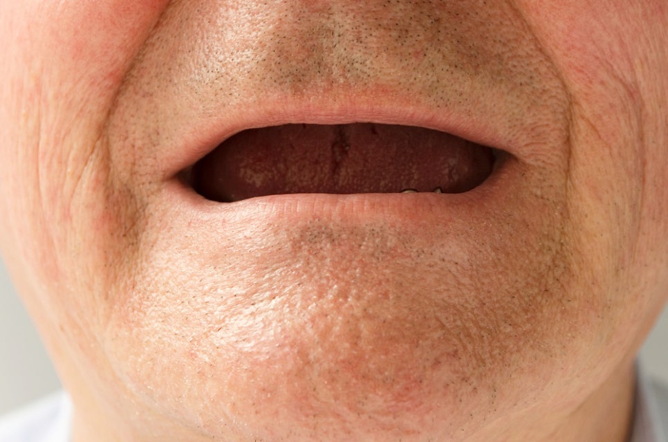 압구정치과 뼈이식 없는 임플란트 알아본다면 관련 이미지 5