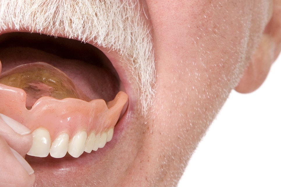 압구정로데오역 치과 불편한 틀니 대신 풀아치 임플란트! 관련 이미지 15