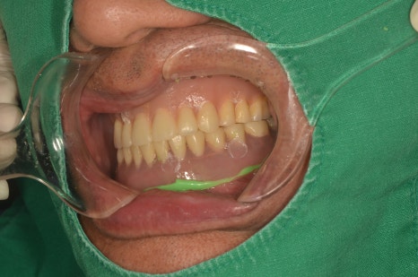 The Misconception That Full-Arch Implants Are Always Difficult for Patients with Diabetes image 12