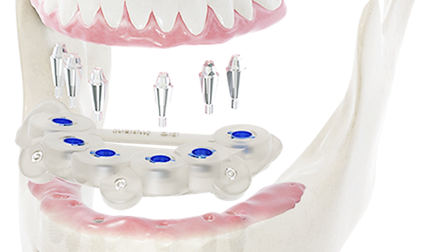 압구정 임플란트종류추천 알아보세요 관련 이미지 4