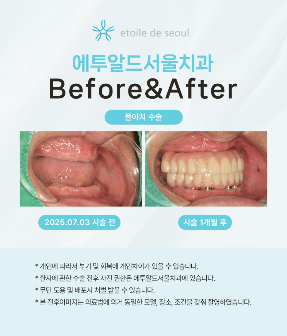 압구정치과 풀아치임플란트 회복기간 얼마나 필요할까 관련 이미지 3
