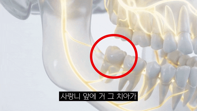 잇몸 염증 임플란트, 바로 심을 수 있을까요? 염증부터 치료해야 하는 경우 관련 이미지 6