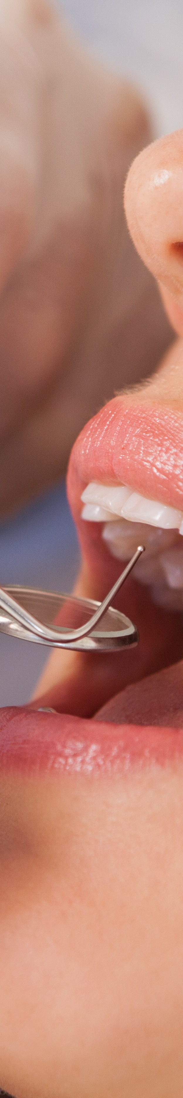 최소 삭제 라미네이트 치아를 지키며 아름다움 더하기 관련 이미지 29