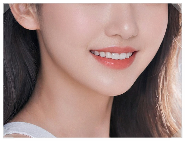Cheongdam Partial Veneers for Front Teeth: Treat Only the Areas That Need It image 4