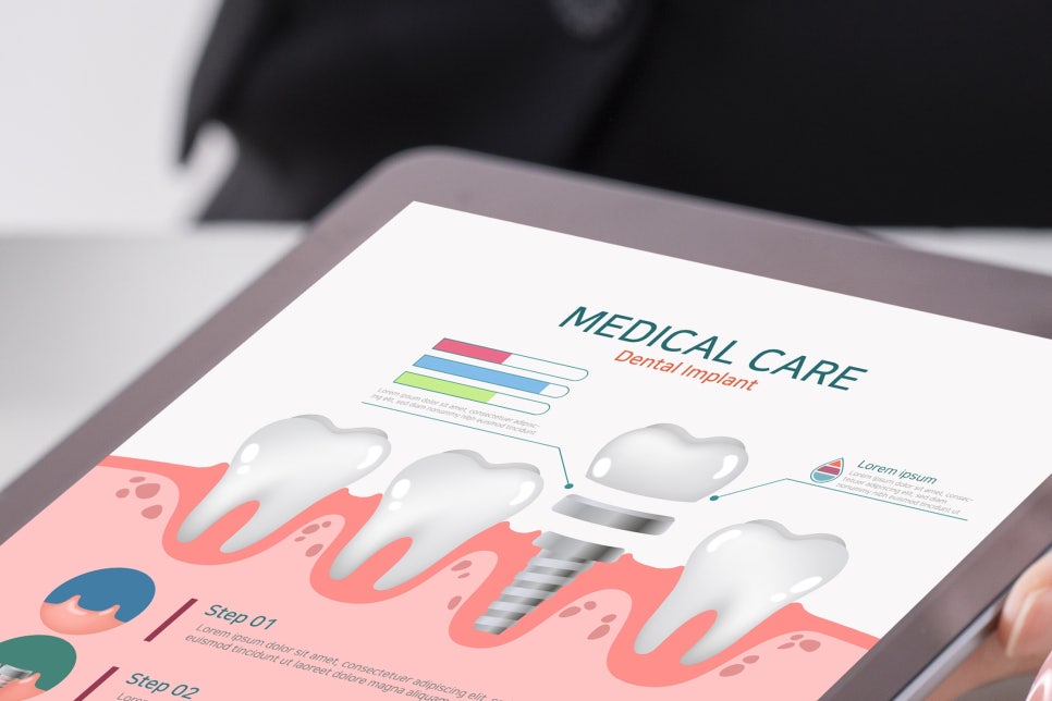 풀아치임플란트 잘하는곳 다수 식립 비용이 부담이라면 관련 이미지 14