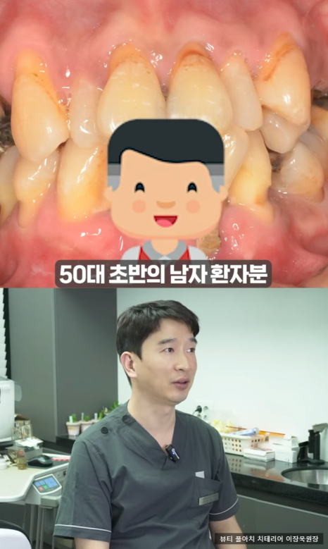 임플란트의 역사와 구조, 풀아치 임플란트 구조 차이점 비교 관련 이미지 7
