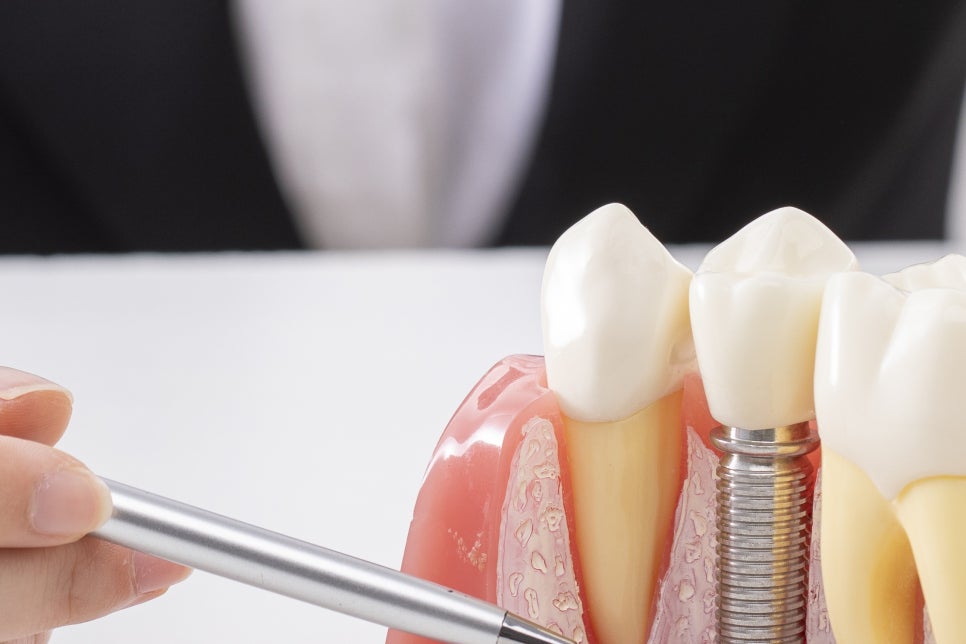 청담 임플란트 치과 미룰수록 독이에요! 관련 이미지 13