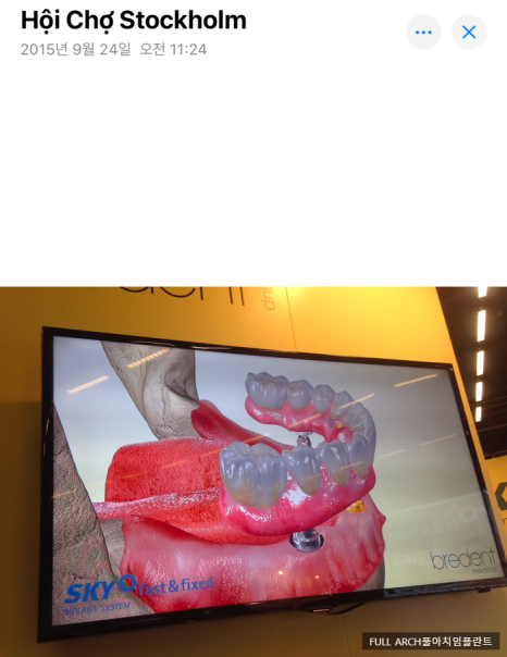 임플란트의 역사와 구조, 풀아치 임플란트 구조 차이점 비교 관련 이미지 3