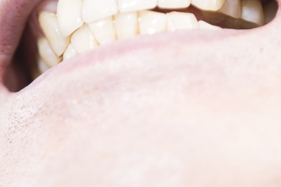 청담동 임플란트 불편함을 줄인 방법 관련 이미지 22