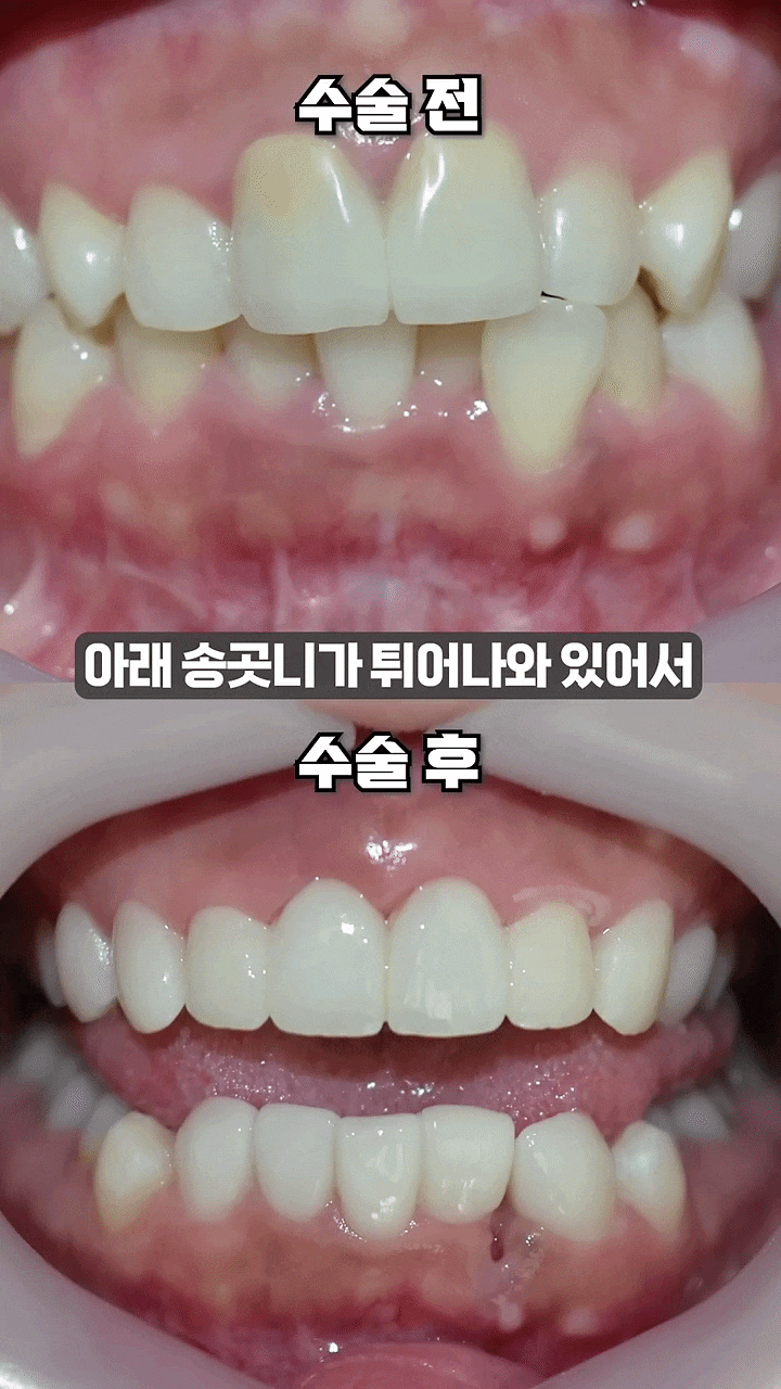 4 Reasons Why the Cost of No-Prep Veneers in Gangnam Varies image 4