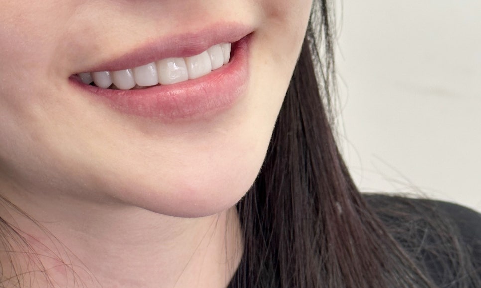 신사동치과라미네이트 치아 삭제 하는 이유 관련 이미지 6