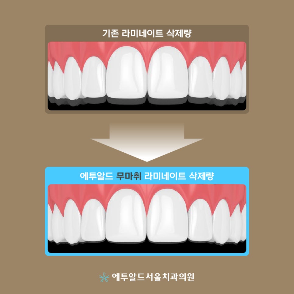 예쁜데 치아까지 예뻐 : 무삭제 라미네이트 관련 이미지 5
