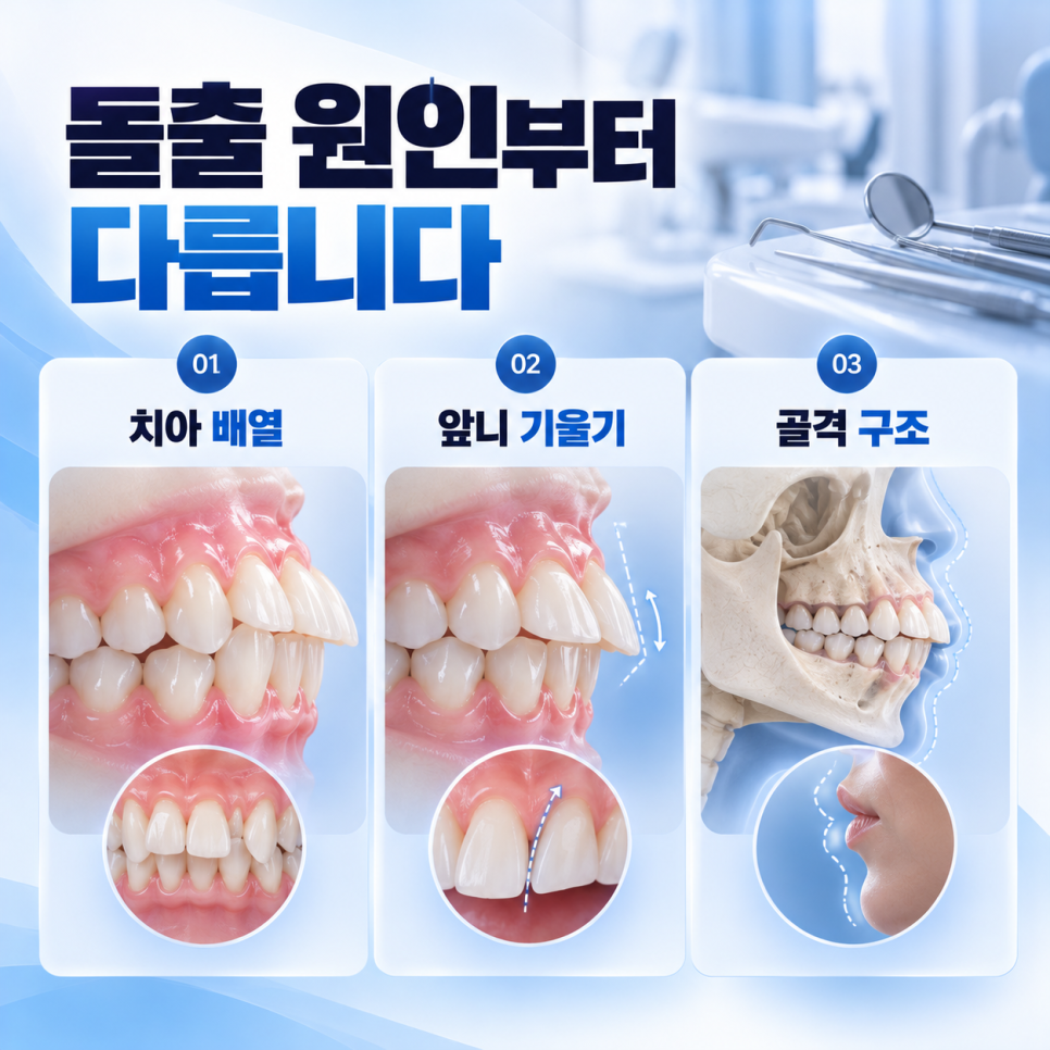 돌출입 라미네이트 가능할까요? 원인부터 짚어보면 [압구정치과] 관련 이미지 3