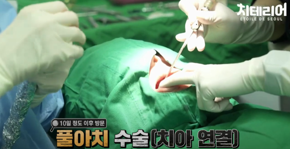 강남풀아치 무치악을 극복하기 위해! 관련 이미지 6