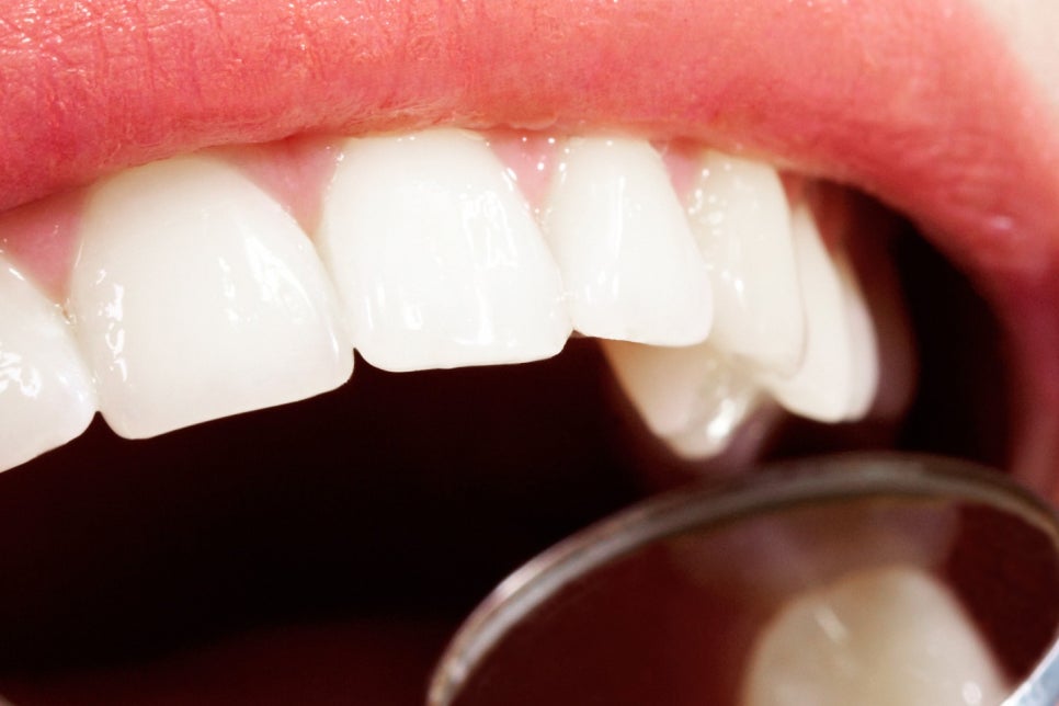 학동사거리 전악임플란트 치과 선택 시 이건 알아두자 관련 이미지 14