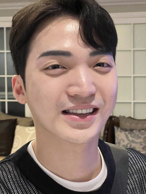 Worried That Apgujeong Veneers Might Be Too White? image 3