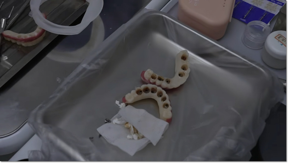 노본아치 임플란트 회복기간 뼈이식 없으면 더 빠른지 비교하기 관련 이미지 12