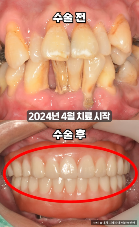 임플란트의 역사와 구조, 풀아치 임플란트 구조 차이점 비교 관련 이미지 13
