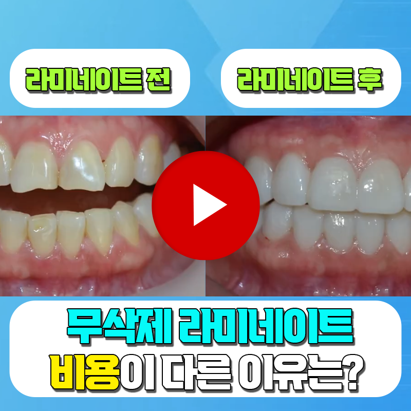 4 Reasons Why the Cost of No-Prep Veneers in Gangnam Varies image 2