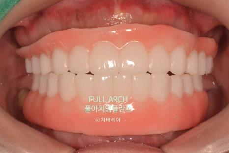 풀아치임플란트 무엇? full-arch Process 부작용과 주의할 점. 관련 이미지 11