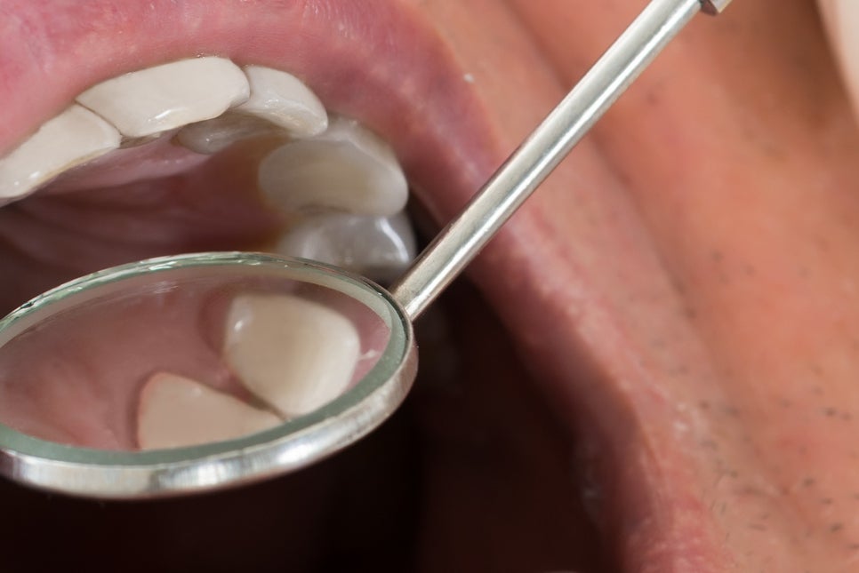 강남 노인임플란트 삶의 질이 달라져요 관련 이미지 13