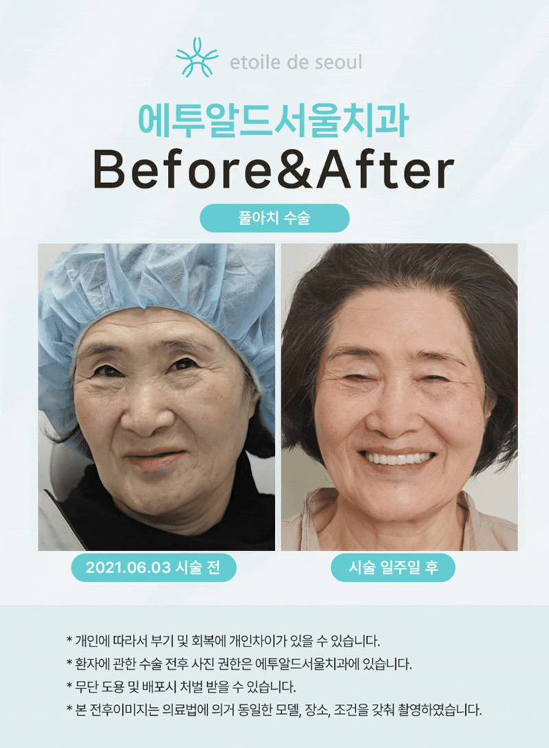 강남임플란트잘하는곳 치과 자세하게 알아보세요 관련 이미지 3