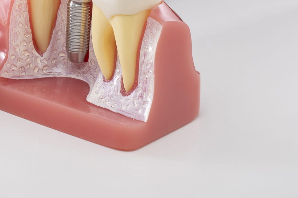 풀아치임플란트 잘하는곳 다수 식립 비용이 부담이라면 관련 이미지 18