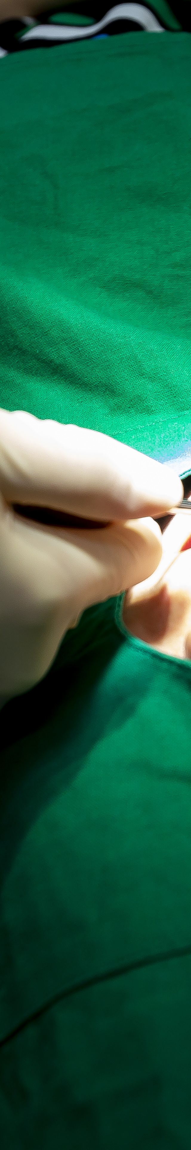 아랫니 라미네이트 숨겨왔던 미소를 되찾는 여정 관련 이미지 17