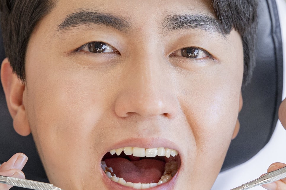 학동사거리 임플란트 심미성을 향상시켜요 관련 이미지 22