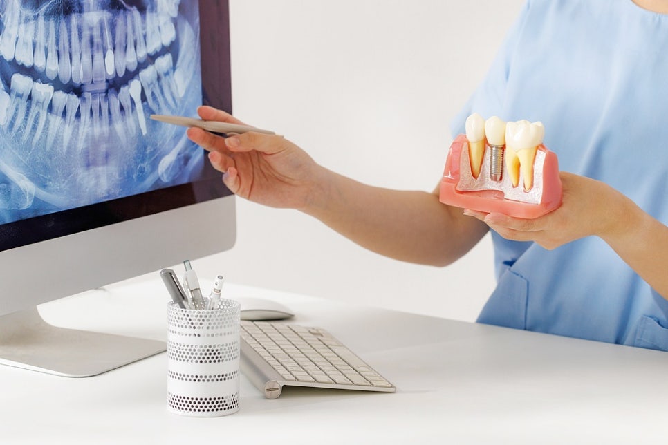 압구정 부분임플란트 가격 비교를 위해 관련 이미지 7