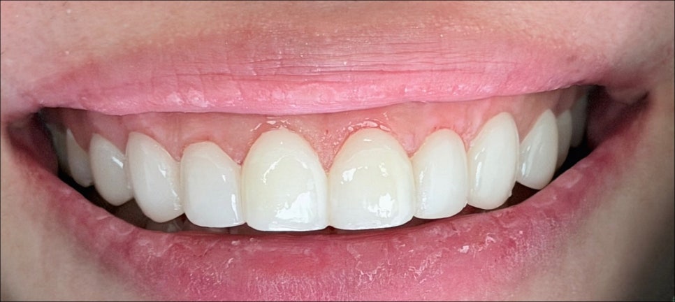 What Makes Apgujeong No-Prep Veneers Different? image 3