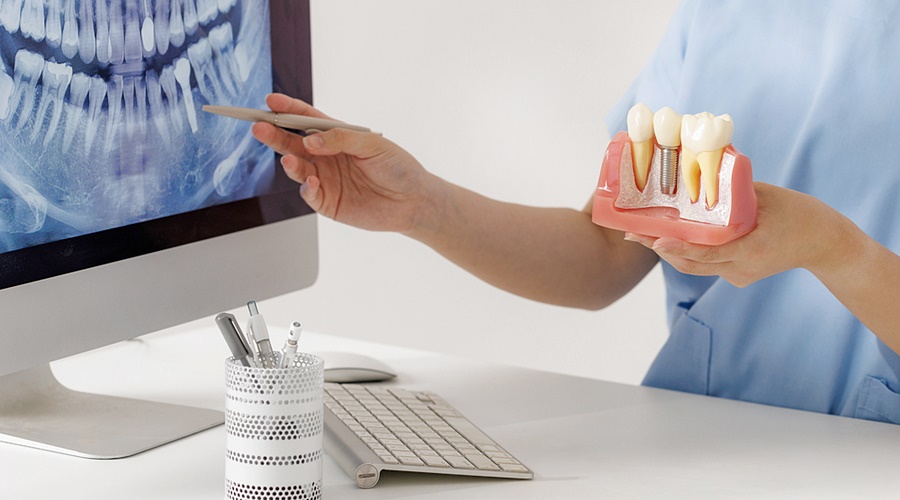 임플란트 발치 후 음주 vs 금주 회복 속도 차이는 관련 이미지 5