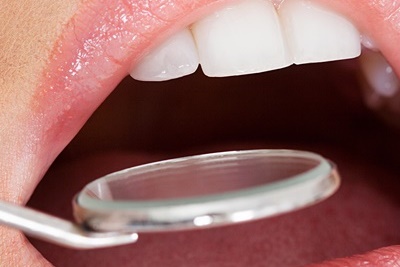 청담동치과 추천 앞니가 부러졌어요! 관련 이미지 14