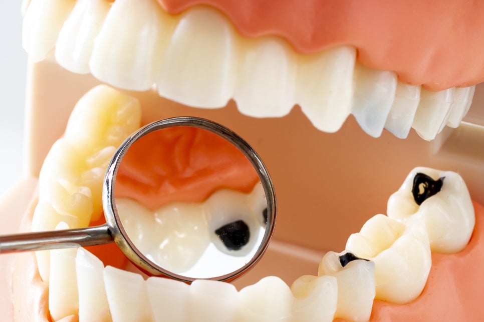 강남 어금니 임플란트 고려가 필요한 4가지! 관련 이미지 13