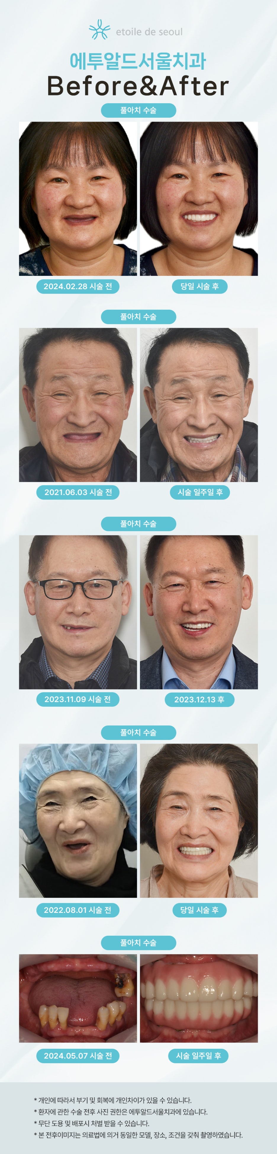 임플란트보험적용나이 기준을 체크하자 관련 이미지 15