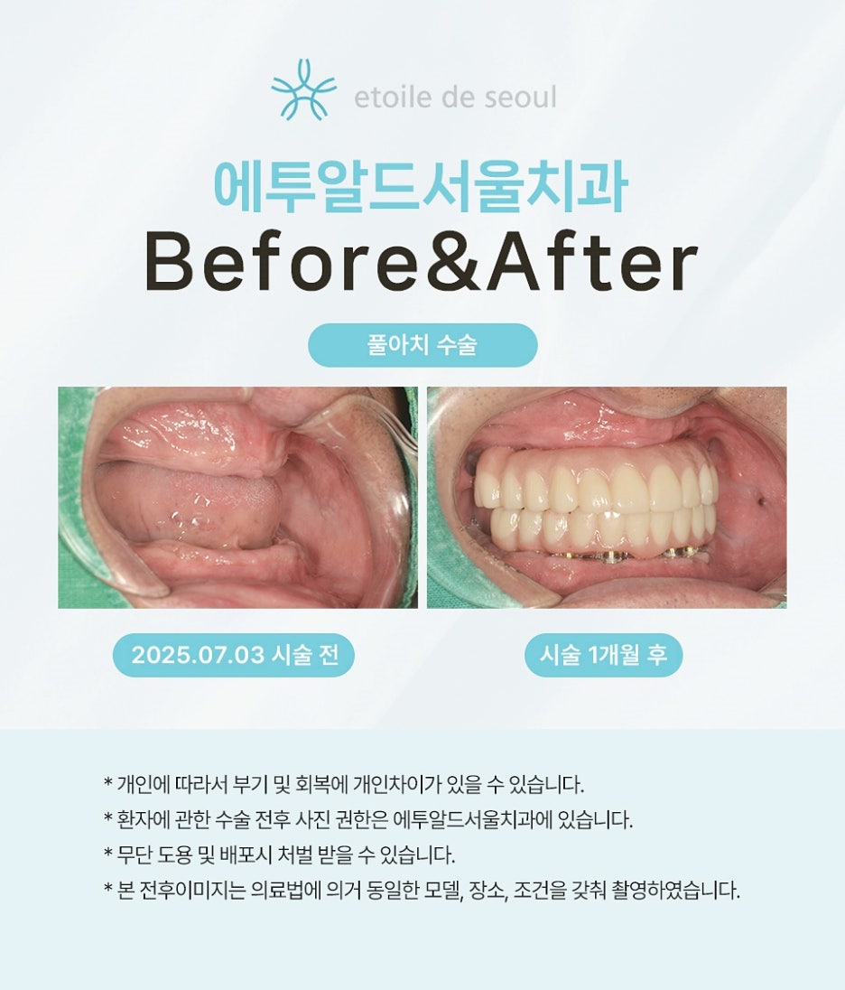 무절개임플란트 비용 통증을 줄이는 방법 관련 이미지 6